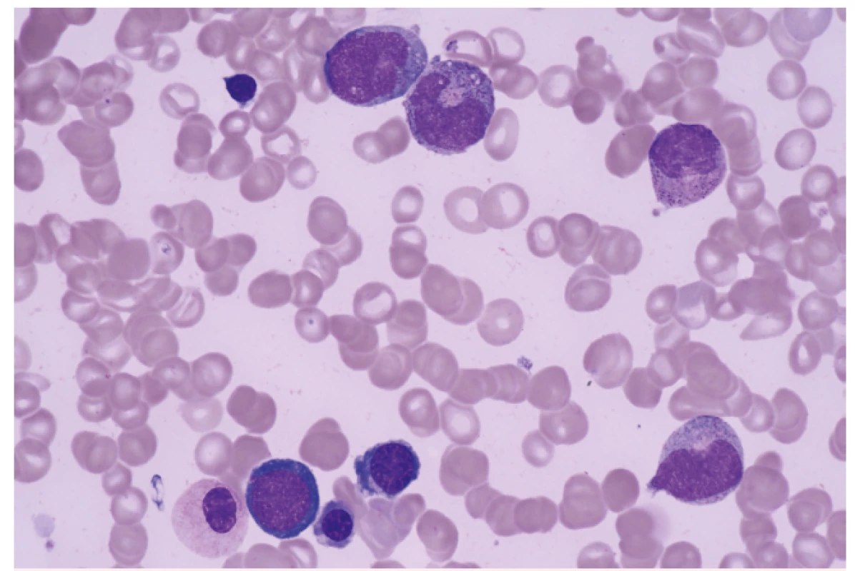 Dysplastické změny v erytropoéze a granulopoéze u nemocného s MDS