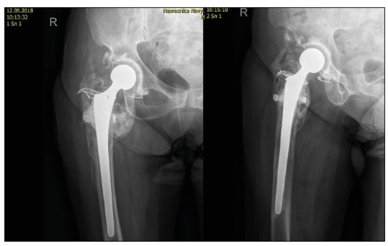 70letá žena s tříštivou zlomeninou trochanterického masivu a
nekrózou hlavice femuru, kontrolní RTG po implantaci TEP s dříkem
Centrament