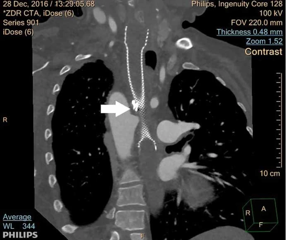 Místo píštěle v úrovni metalického stentu (označeno šipkou).<br> Fig. 3. Location of fistula at the level of the metallic stent (marked by an arrow).