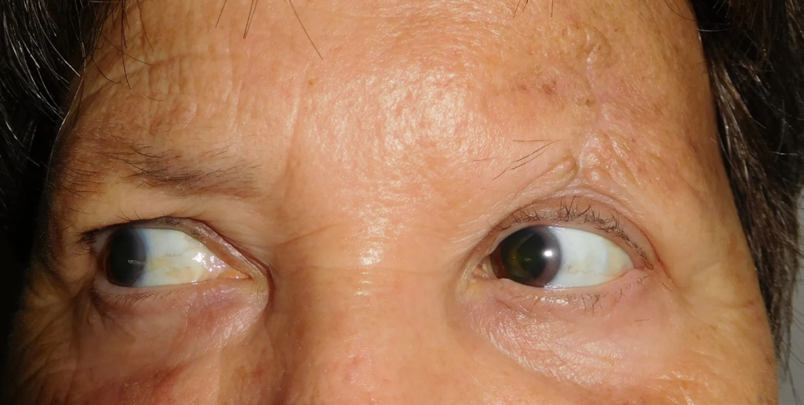 Patient 2 – detail of scar of upper eyelid with no recurrence
of MCC in September 2017