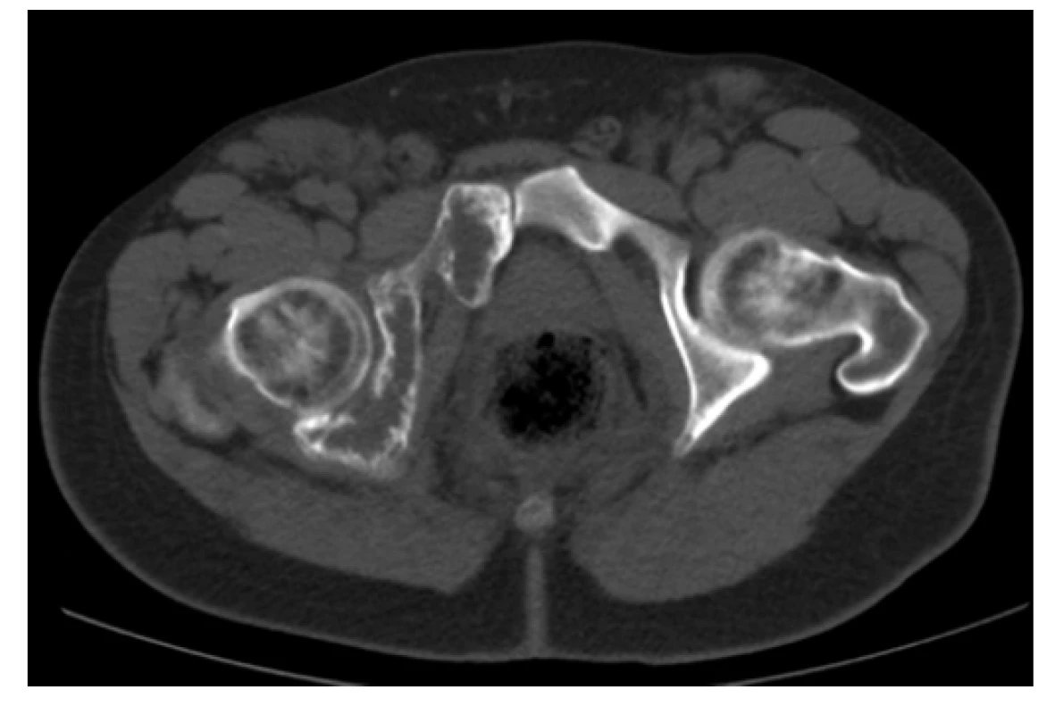 CT scan (axiální rovina), kostní okno – osteolytické změny acetabula
a os pubis vpravo