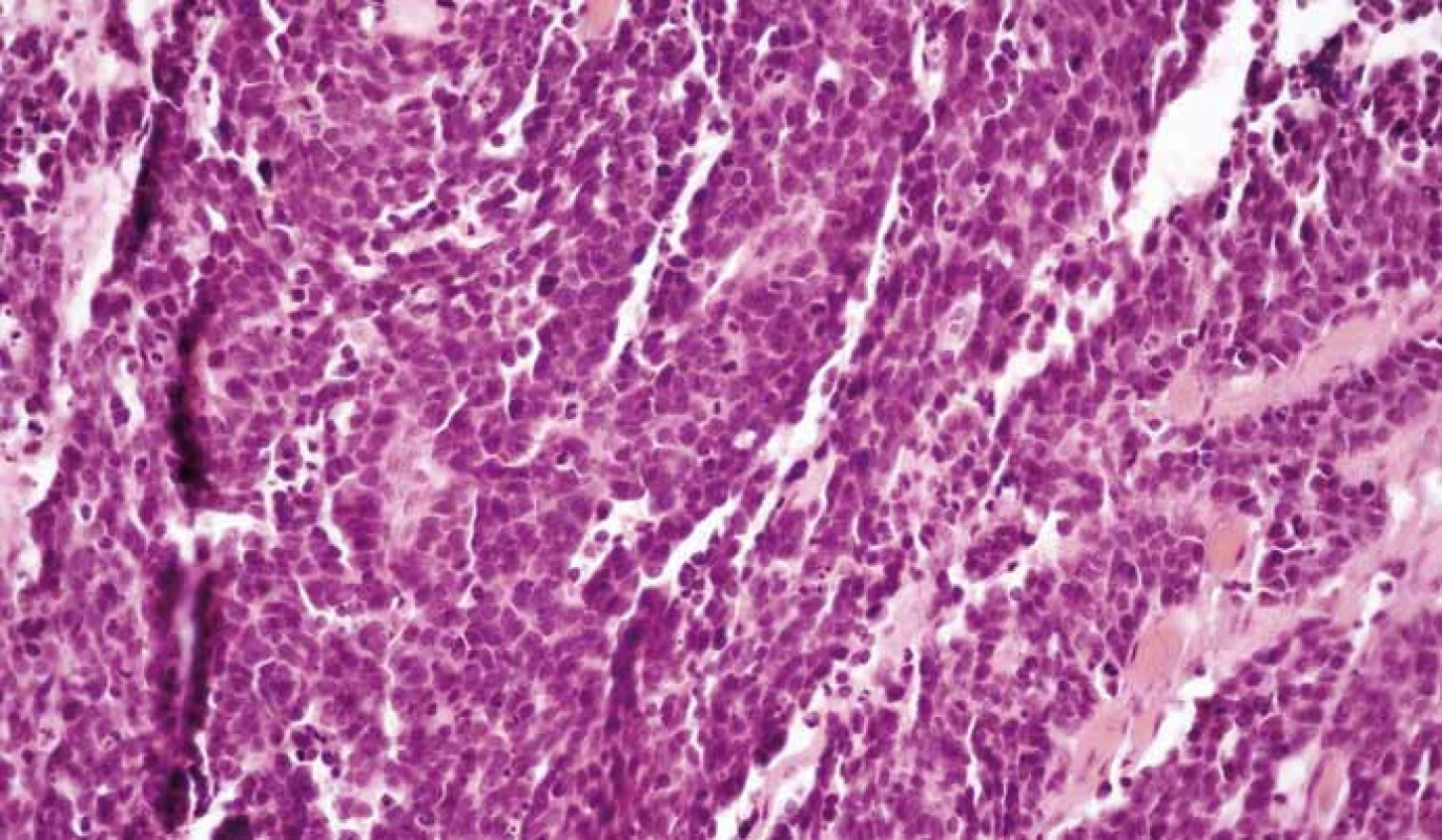 Neuroendokrinný karcinóm G3. Hematoxylín eozín, 400×.
