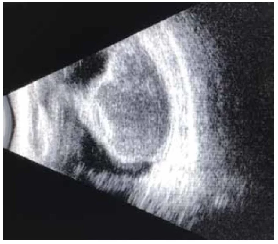 B-scan revealed massive suprachoroidal hemorrhage
