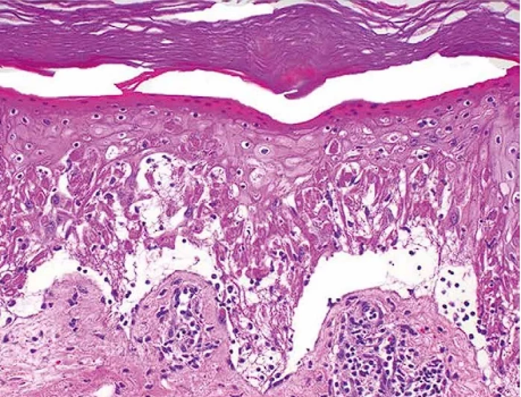 Toxická epidermální nekrolýza, časná stádia – histopatologický obraz. Apoptotický zánik keratinocytů epidermis s přítomností tzv. satelitních nekróz. Hematoxylin-eozin, pův. zvětšení 200x.