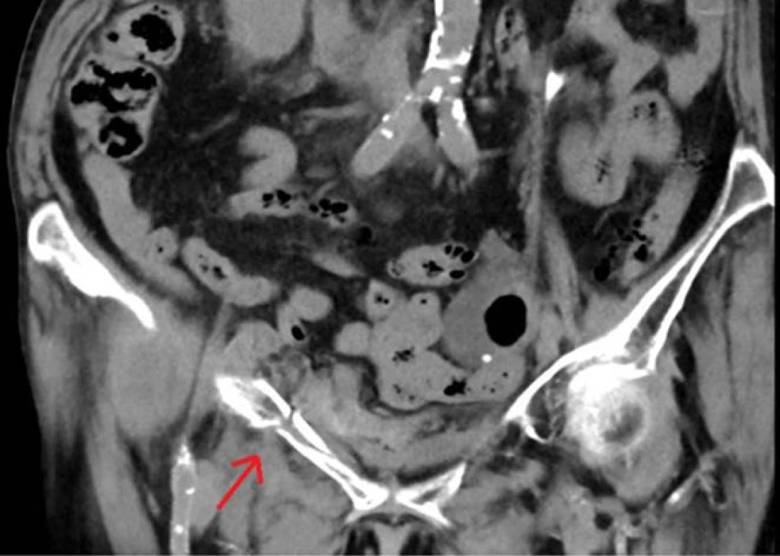 Nativní CT koronární
řez, šipka ukazuje frakturu
horního raménka stydké kosti
vpravo<br>
Fig. 1. Non contrast CT coronal
section, the arrow shows
the fracture of the right superior
pubic rumus