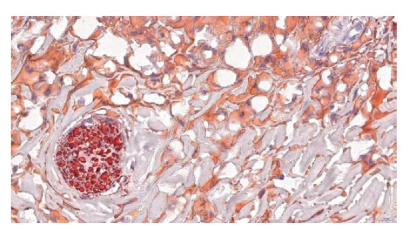 Histologie zmraženého řezu obarveného olejovou červení, která
vykazuje silnou afinitu k myelinovým pochvám periferního nervu a slabší
afinitu k lipidovému materiálu uvnitř makrofágů, 49.3x.