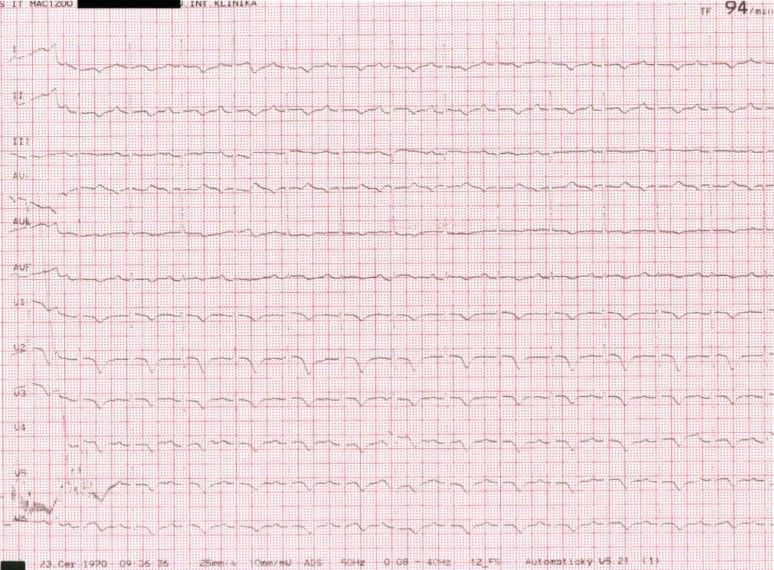 4 EKG po preklade z NÚSCH 