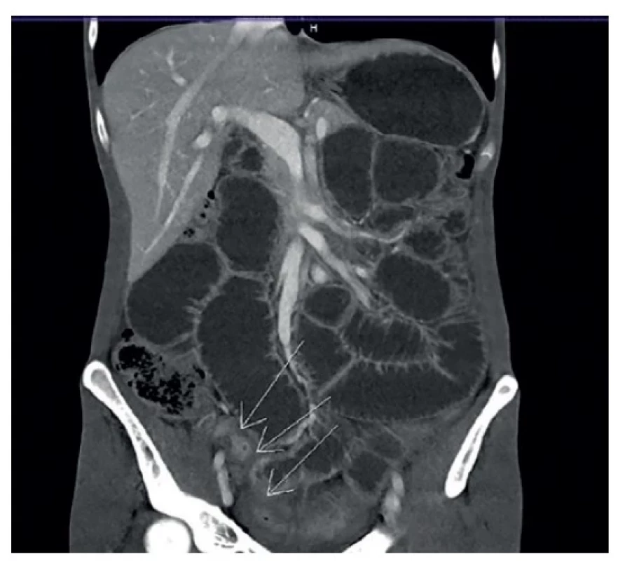 Koronální CT řez − rozsah stenózy a zánětu terminálního
ilea<br>
Fig. 2: Coronal CT section − extent of the stenosis and inflammation
of the terminal ileum
