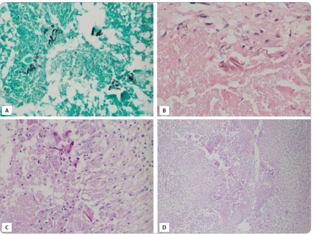 Mikroskopický nález hýf mukoru vo vyšetrenom tkanive z CNS – granulomatózny, nekrotizujúci zápal CNS s mykotickými
organizmami.<br>
A. Grocottove farbenie 40×.
B. Hematoxylín-eozín 40×.
C. PAS 40×.
D. PAS 10×.
(Ústav patologickej anatómie, JLF UK a UN Martin, 2018)
CNS – centrálna nervová sústava, PAS – periodic acid schiff