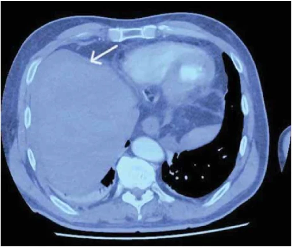 Úzký denzní proužek s denzitami 60 HU kolem jater, možnost čerstvého krvácení. <br> 
Fig. 1. Narrow densional strip with 60 HU densities around the liver, possibility of fresh
bleeding.