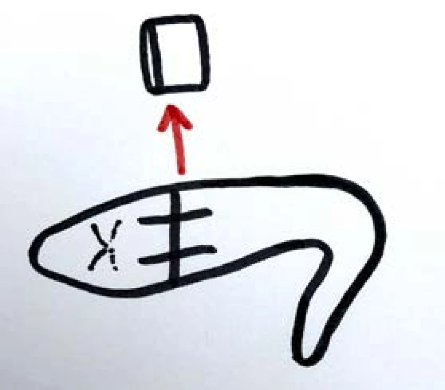 Zmenšení laterálních krur