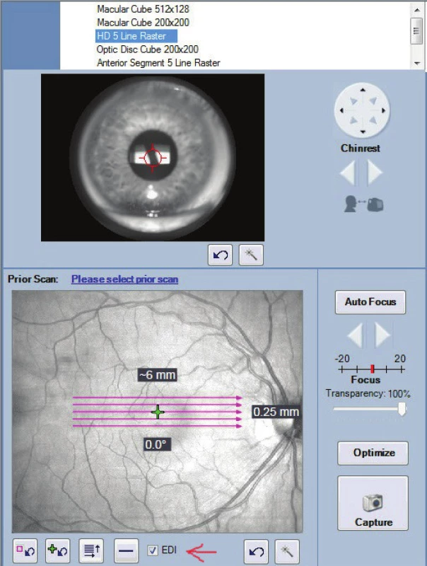 The EDI module (Cirrus Zeiss HD-OCT) is marked with the red arrow.