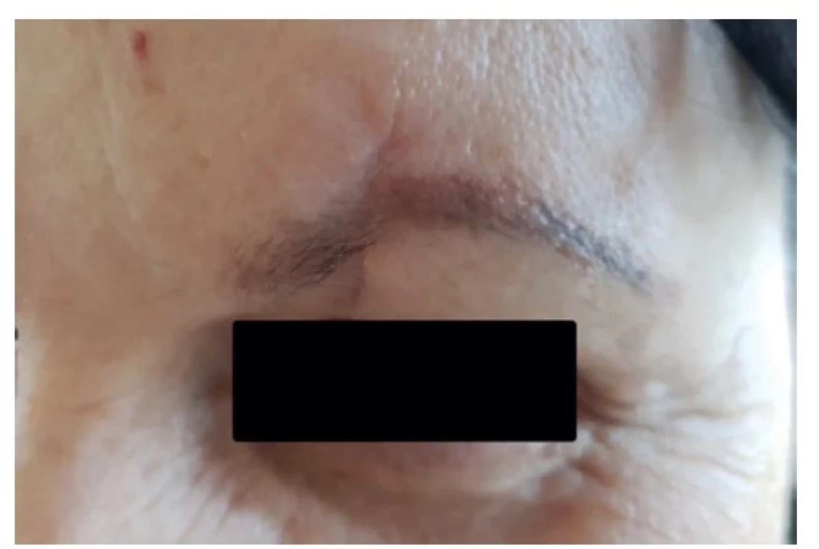 Stav 2 měsíce po chirurgické korekci jizvy<br>
Fig. 4: Condition two months after surgical revision of the
scar
