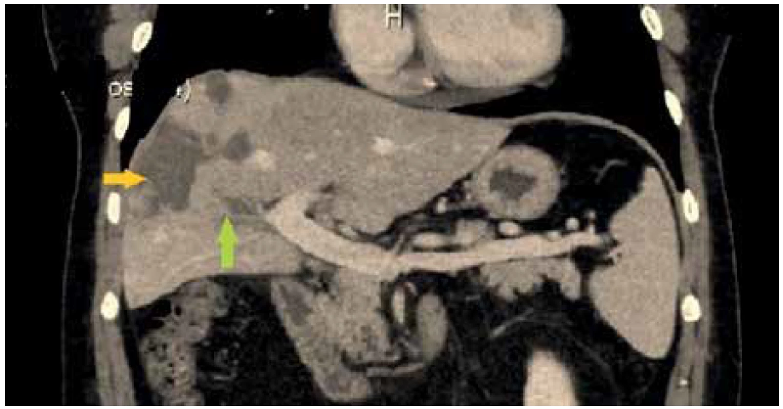 CT obraz s obliterovanou portální větví pro segment V a VIII (zelená šipka), hypoperfuzní
změny v okolí (žlutá šipka)<br>
Fig. 3. CT scan with occluded portal branch for segments V and VIII (green arrow), surrounded
with hypoperfusion of the liver parenchyma (yellow arrow)