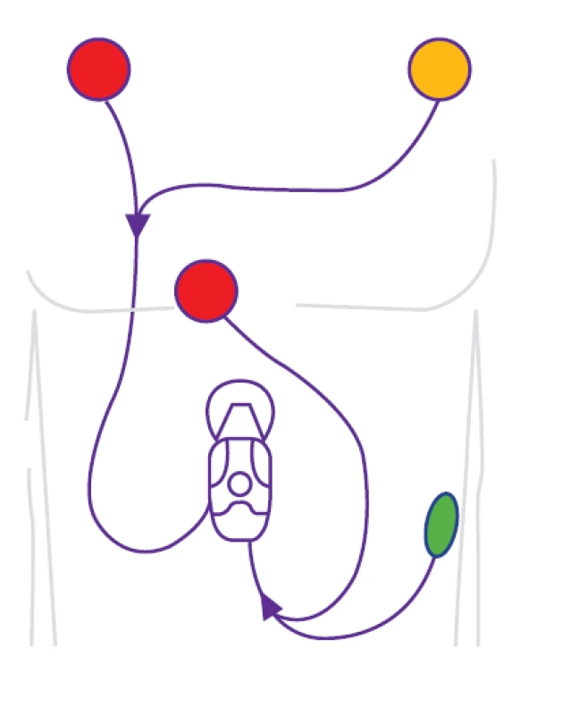 Ambulantní telemetrie EKG