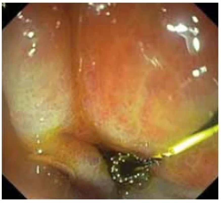 Malpozice stentu do stěny
duodena. <br> 
Fig. 4. Malposition of the stent in the wall of
the duodenum.