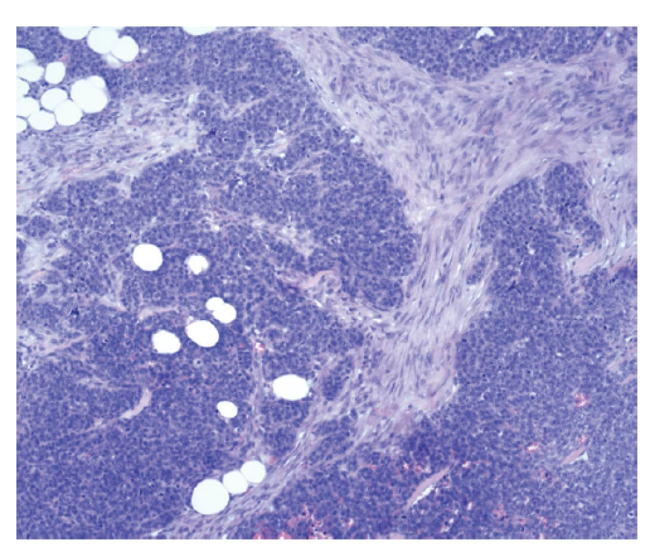 Přítomnost maligní epiteliální komponenty, stroma
je zde suspektní, nicméně nesplňuje jednoznačná kritéria
malignity.<br>
Fig. 9: The presence of the malignant epithelial component,
the stroma is suspicious, however, it does not meet
criteria for malignancy.
