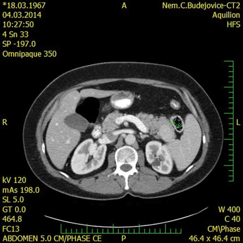 CT s nálezem intrapankreaticky uložené akcesorní sleziny (IPAS) (šipky).
Fig. 3. A CT scan showing an intrapancreatic accessory spleen (IPAS) (arrows).