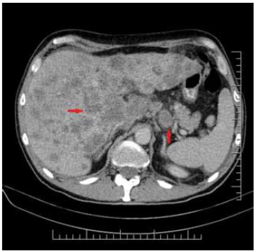 Tumour of pylorus – asymetric
thickening of the wall – coronary
projection.<br>
Obr. 4. Tumor pyloru – asymetrické
zhrubnutie steny – koronárna projekcia.