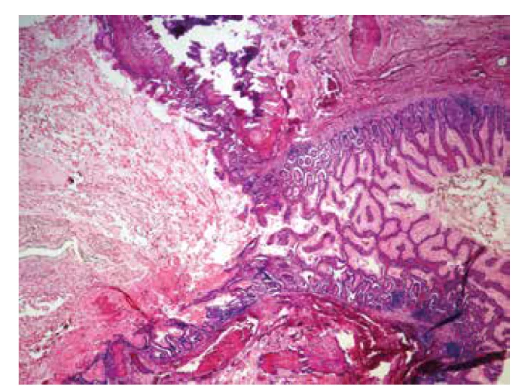Ileum a stena Meckelovho divertikula vystlaná epitelom tenkého
čreva (hematoxylín-eozín, zväčšenie 40x).