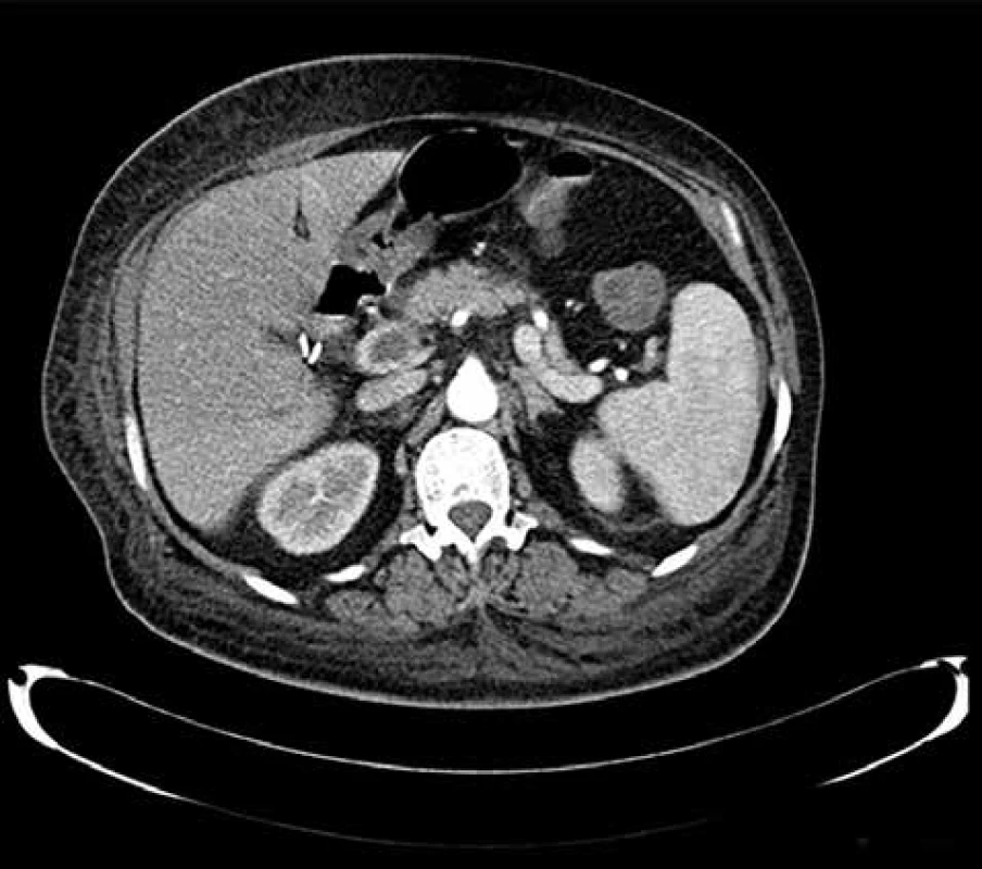 Trombóza portální žíly<br>
Fig. 5: Portal vein thrombosis