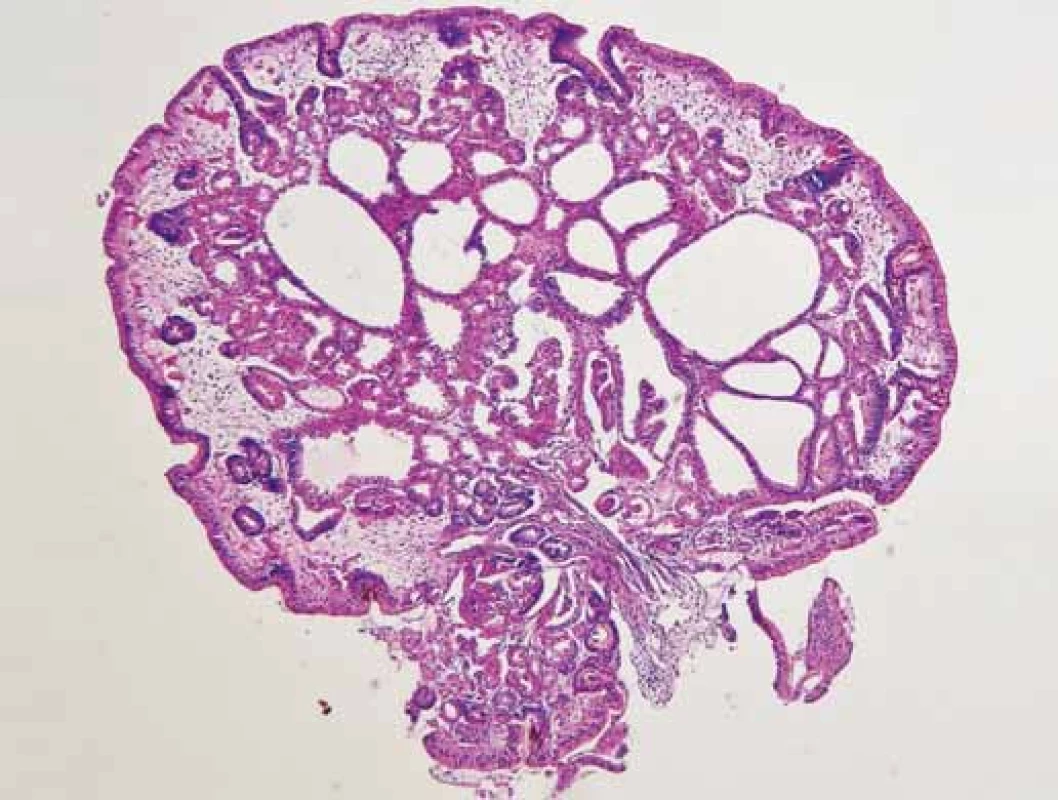 Polyp žaludku (barvení hematoxylin-eozinem,
zvětšení 40×).