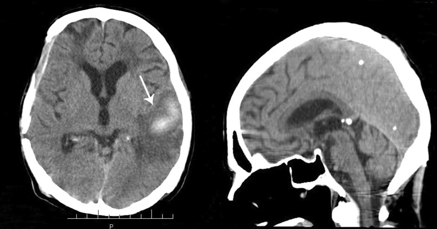 A – resolution of the previously observed contusion and hematoma
of the left temporal lobe. B – CT scan (sagittal section), diffuse cerebral and
cerebellar atrophy, complete resolution of the previously observed subdural
hematoma in the posterior fossa.