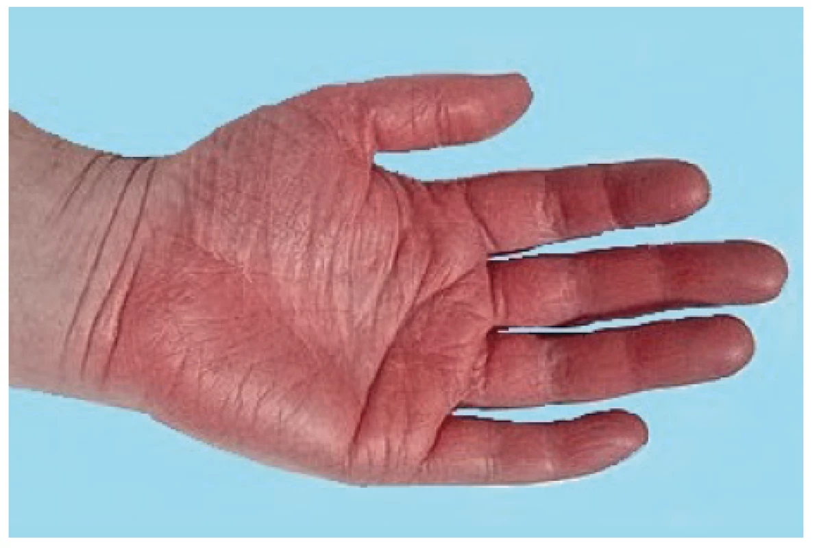 Erytromelalgie