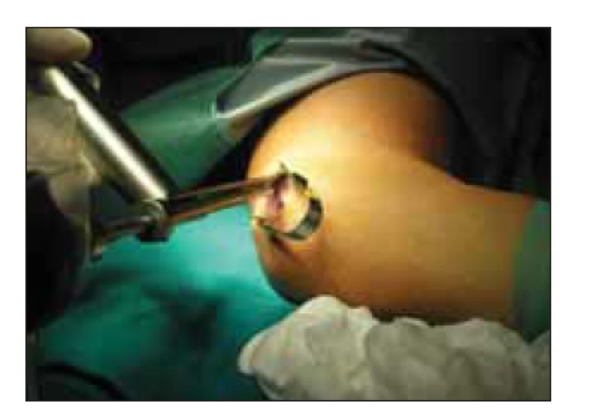 Zavedení endoskopu s integrovaným
retraktorem do proximální podkožní
kapsy.<br>
Fig. 3. Retractor integrated endoscope is
introduced into the proximal subcutaneous
pocket.