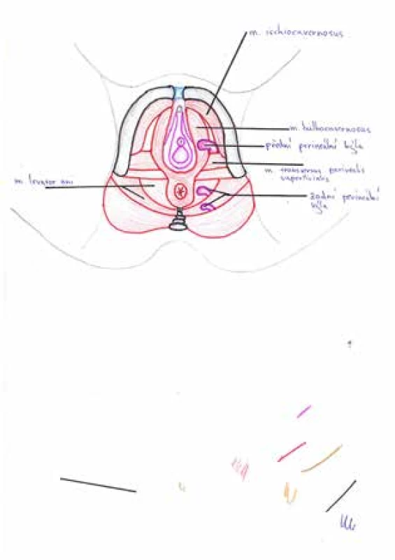 Pozice perineálních kýl vzhledem ke svalům pánevního dna, pacientka v litotomické poloze<br>
Fig. 4: Position of perineal hernia in pelvic floor; patient in
the lithotomy position
