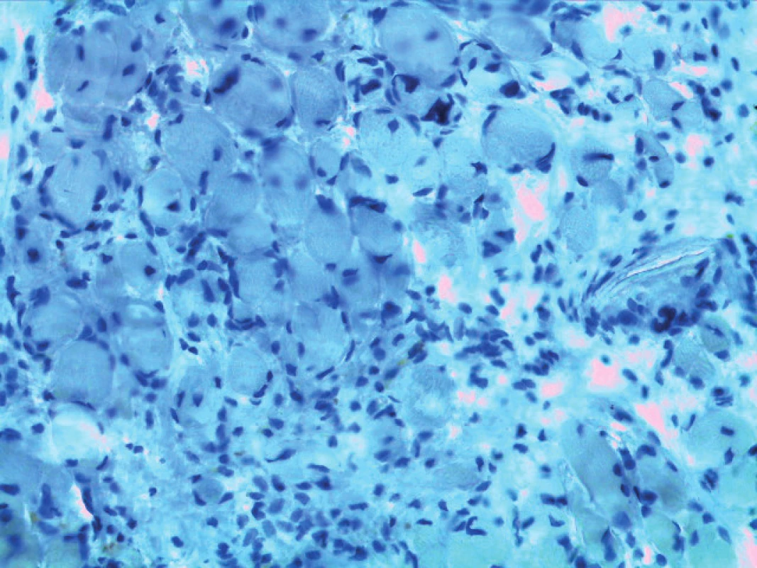 a,b. Histological and immunohistochemical findings.<br>
a) Haematoxylin and eosin staining (magnification 400 x). Muscle fibres and reactive proliferation of the connective tissue are present<br>
b) Immunohistochemical staining: S-100 protein negative (magnification 400 x)<br>
(With permission of Department of Pathology of the Military University Hospital Prague, Czech Republic)