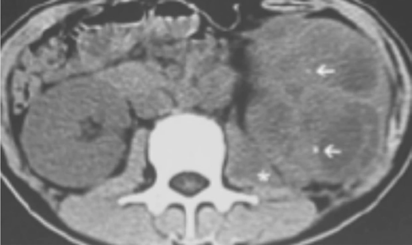 CT vyšetření: na transverzálním
řezu jsou patrné mnohočetné
kaverny levé ledviny<br>
Fig. 2. CT scan: transverse section
with multiple caverns in the
left kidney