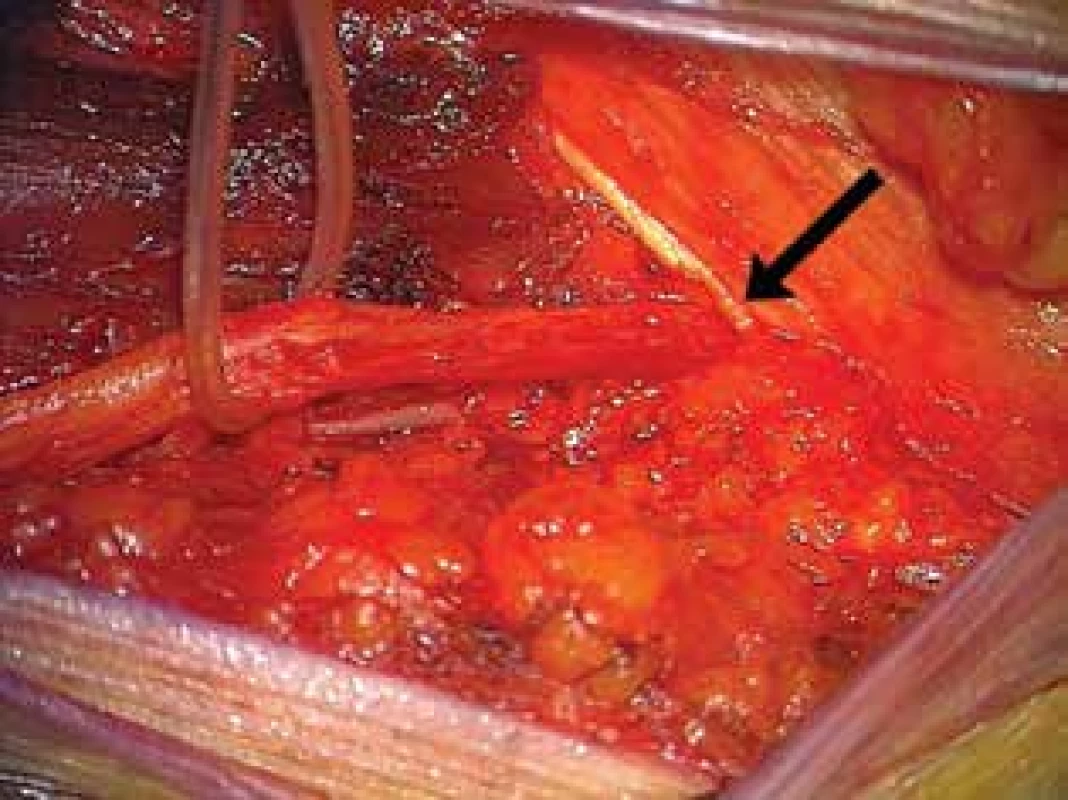 Komprese n. cutaneus femoris lateralis pod lig.
inguinale vlevo (šipka)<br>
Fig. 4: Compression of the lateral femoral cutaneous
nerve under the inguinal ligament on the left side
(arrow)