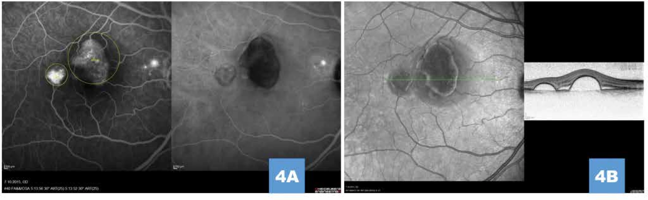 (A) Simultánní snímek fluorescenční a indocyaninové angiografie zobrazující pozdní hyperfluorescenci (pooling) pod ablacemi retinálního pigmentového listu, drobnou ložiskovou hyperfluorescenci v parapapilární oblasti, vyznačení velikosti a umístění stop pro fotodynamickou terapii (žlutá ohraničení); je patrné odstínění plnění choroidey pod serózními ablacemi, snímek zároveň vylučuje přítomnost choroidální neovaskularizace (B) Vysoké ostře odstupující serózní ablace retinálního pigmentového listu na transfoveolárním lineárním snímku před léčbou

