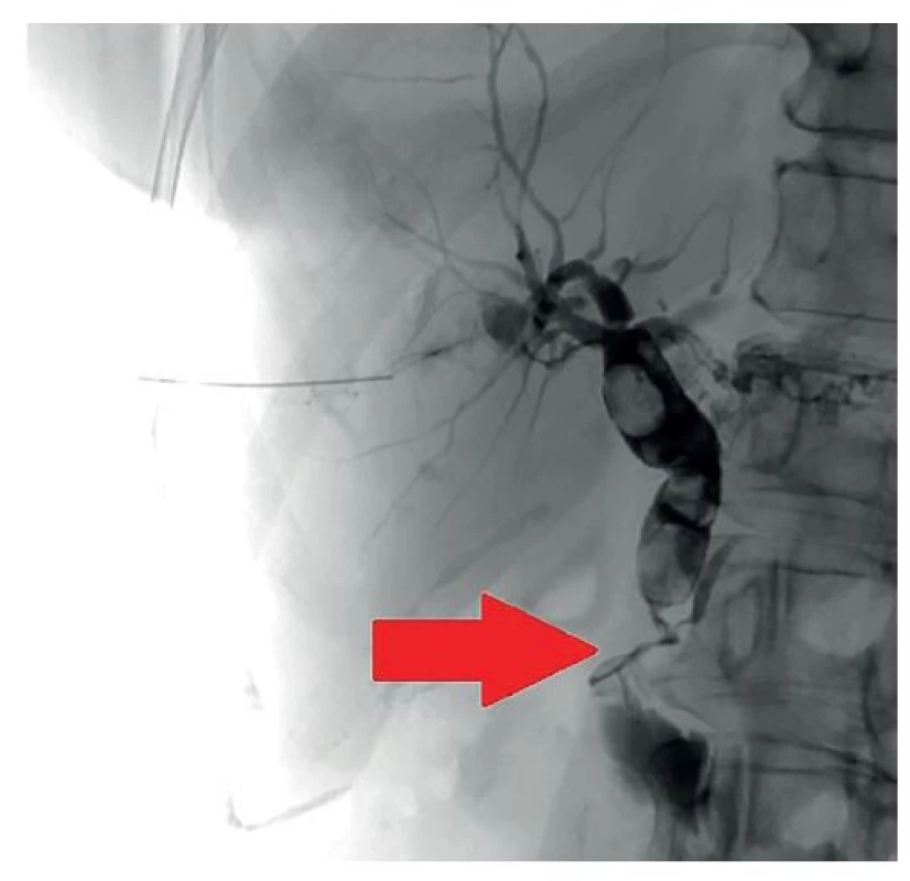 PTC – choledocholitiáza a stenóza distálního choledochu
(šipka)<br>
Fig. 1: PTC – choledocholithiasis and stenosis of the distal
part of the common bile duct (arrow)