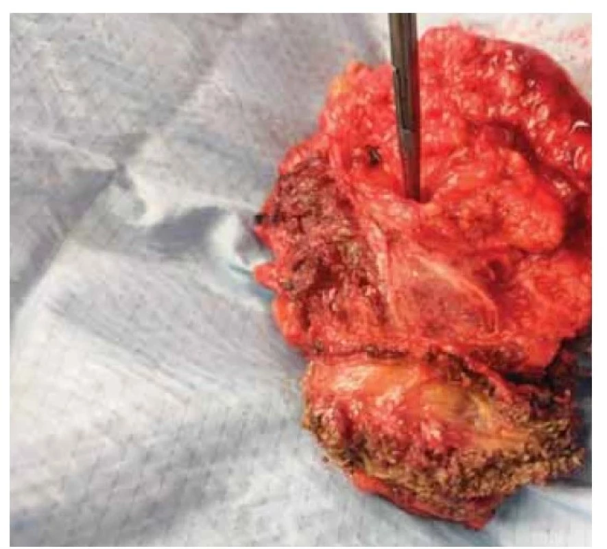 Recidiva karcinomu endometria v břišní stěně po
kompletní excizi.<br>
Fig. 1. Recurrence of endometrial carcinoma in the abdominal
wall after complete excision.