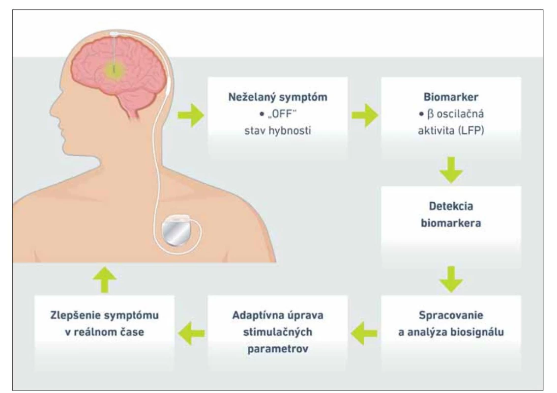 Princíp adaptívnej hlbokej mozgovej stimulácie na príklade pacienta s Parkinsonovou chorobou.<br>
LFP – local field potentials<br>
Fig. 3. Principles of adaptive deep brain stimulation in the context of a patient with Parkinson´s disease.<br>
LFP – local field potentials