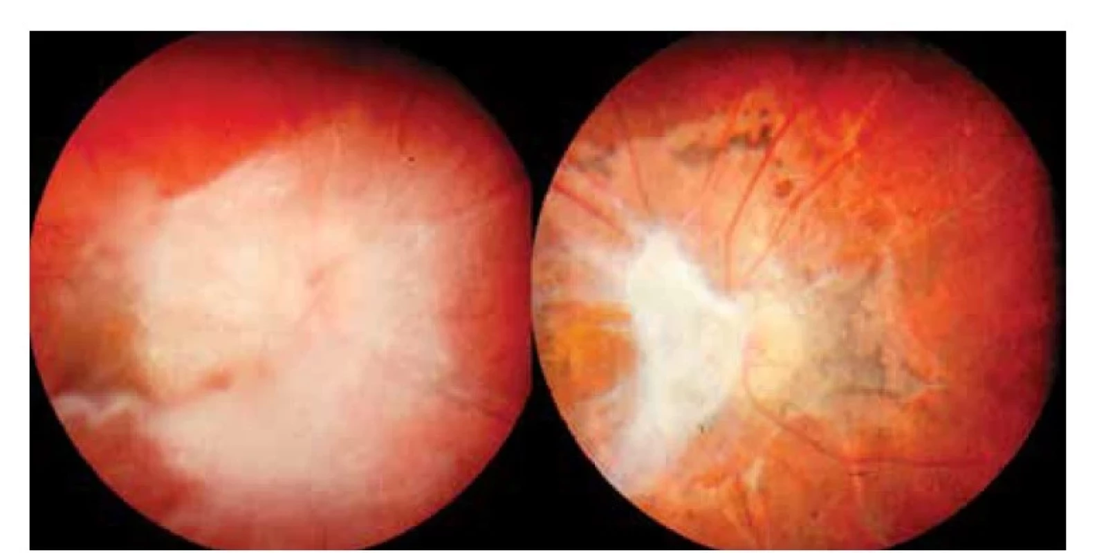 Obraz toxokarové neuropatie s vitritreální reakcí v okolí před celkovou
terapií<br>
Vpravo: Výrazné jizevnaté sítnicové změny s atrofií papily zrakového nervu a zbytky vitreální
membrány po kombinované léčbě o rok později