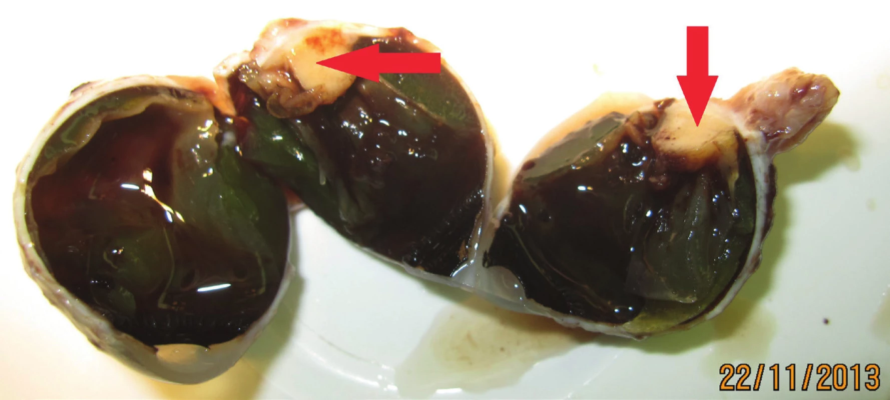 Eyeball after enucleation – arrow indicates tumour deposit