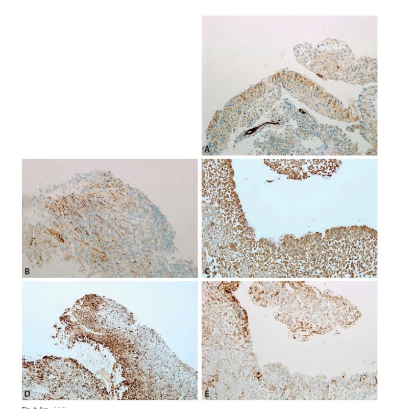 Synovial-like metaplasia of the endometrium, immunohistochemical features. A. Podoplanin positivity in the synovial-like cell layer (lymphatic
capillaries represent a positive internal control) (case 1). B. Podoplanin positivity in perpendicularly arranged cells in the second case (case 2).
C. Vimentin is expressed by both surface synovial-like and deeper stromal cells (case 1). D. CD68 positivity in synovial-like cell layer and in some cells
of the stroma (case 2). E. Variable CD10 expression (case 1) (original magnifi cations 200x in A, C-E, and 400x in B, respectively).
