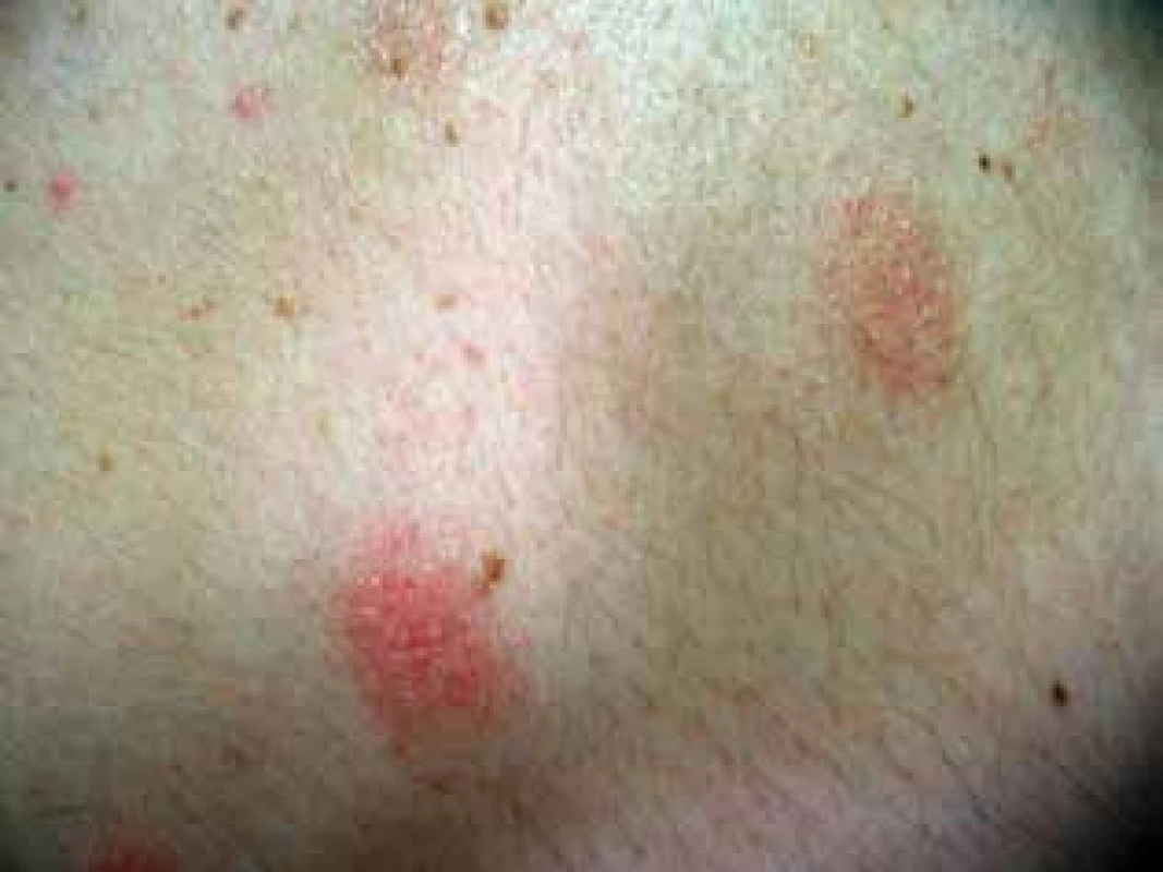 Detail ložiska mucinosis follicularis