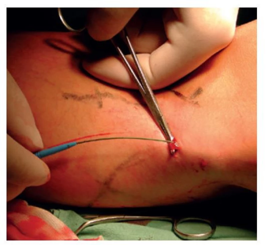 Kanylace safény z miniincize<br>
Fig. 1: Saphenous canulation through miniincision