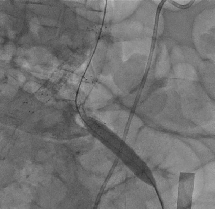Stentgraft a. iliaca communis sinistra<br>
Fig. 3. Left common iliac artery stent graft