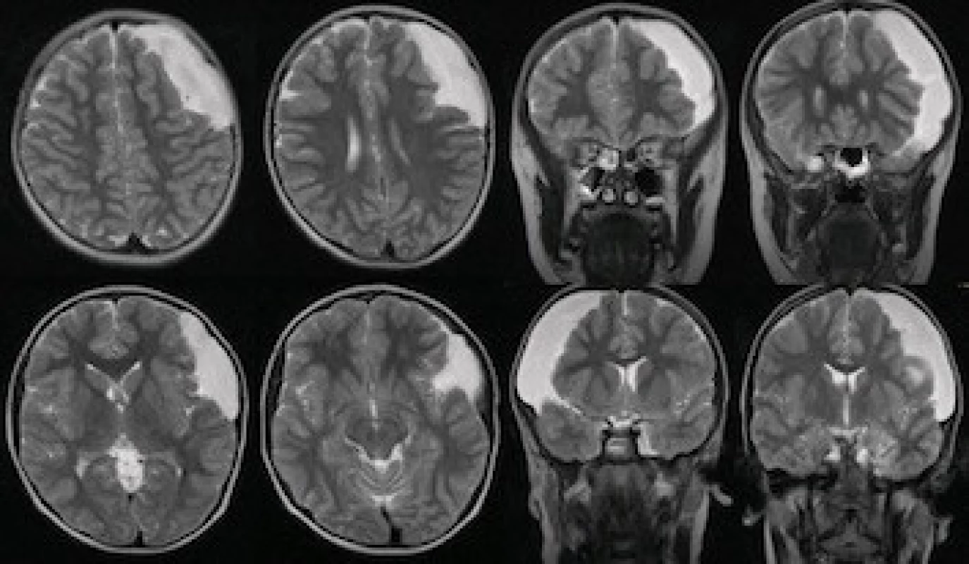 Fig. 1. A Galassi III middle fossa cyst diagnosed at the age of 6.<br>
Obr. 1. Galassi III cysta střední jámy lebni diagnostikována v 6 letech.

