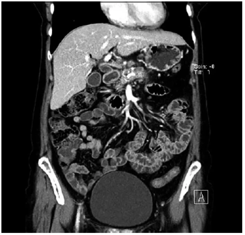 Předoperační CT u nemocné s bolestivou formou
obstrukční chronické pankreatitidy s kalcifikacemi a pankreatikolithiázou,
bez zjevného ložiska <br> 
Fig. 4. Preoperative CT of a painful form of obstructive
chronic pancreatitis with calcifications and pancreaticolithiasis,
without any apparent mass