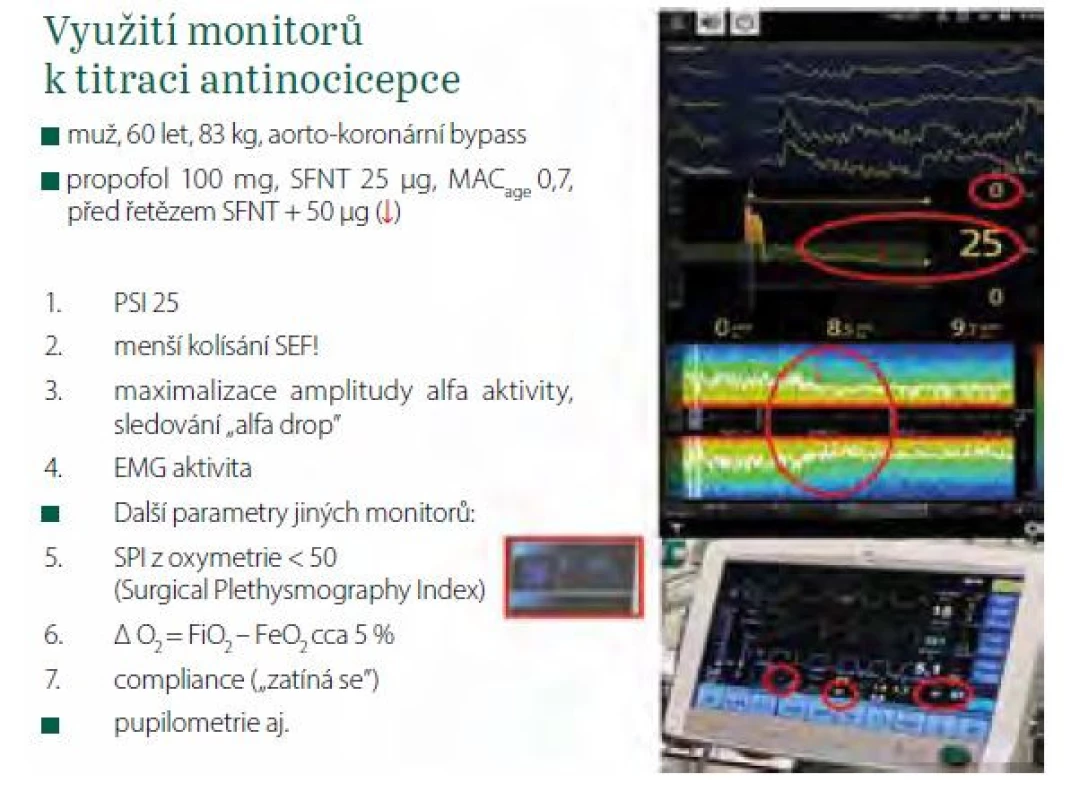 Využití monitorů k titraci antinocicepce. Červeně jsou označeny
parametry, které lze k titraci využít