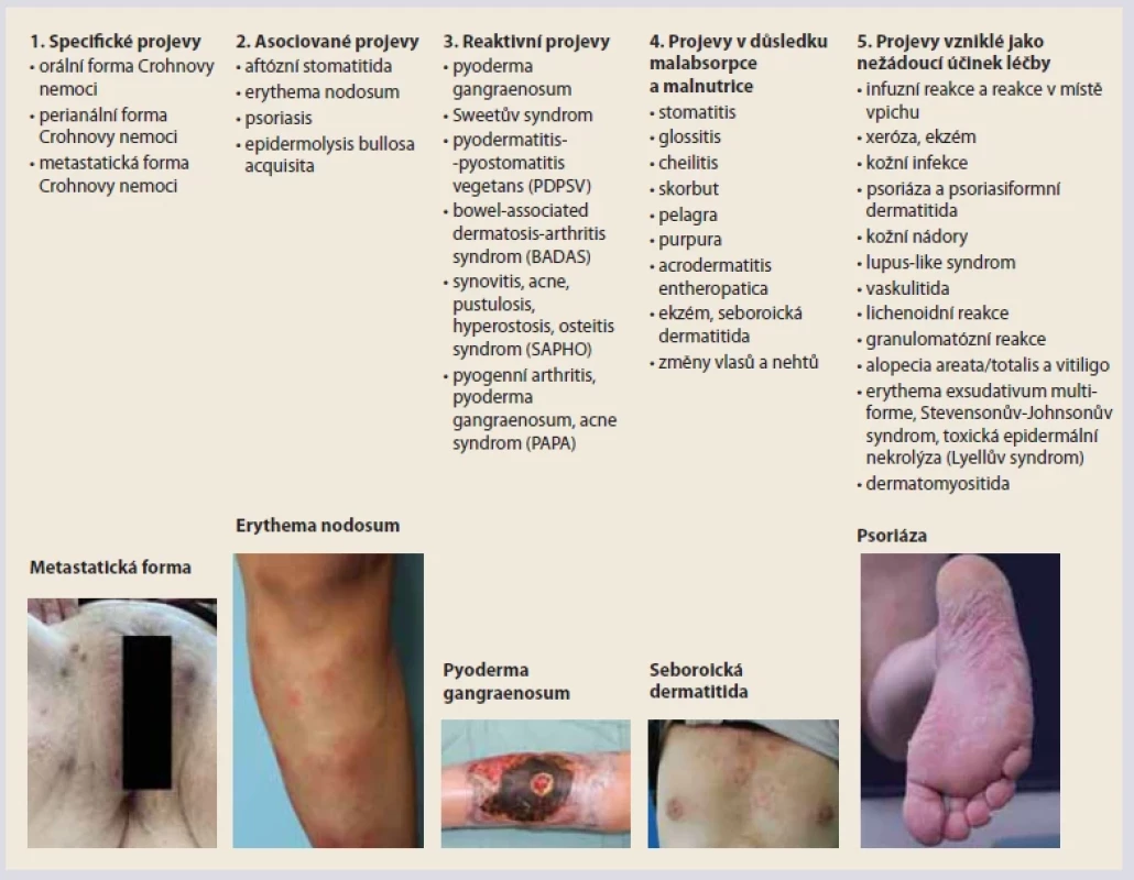 Mukokutánní manifestace IBD [1,3–5]. <br> 
Tab. 1. Mucocutaneous manifestations of IBD [1,3–5].