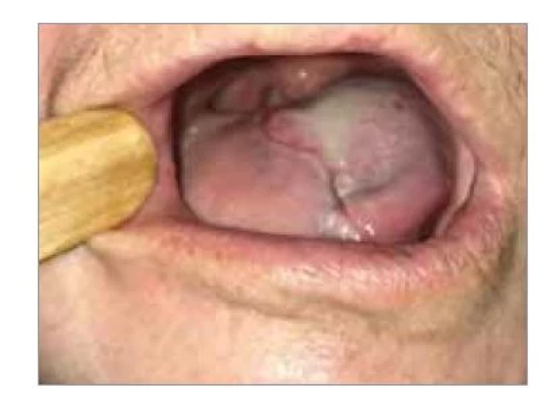 Výsledný stav CTS s rekonštrukciou
infrahyoidným lalokom
vpravo 2 mesiace po operácii.<br>
Fig. 6. Outcome of CTS with infrahyoid
flap reconstruction on the right
2 months after operation.