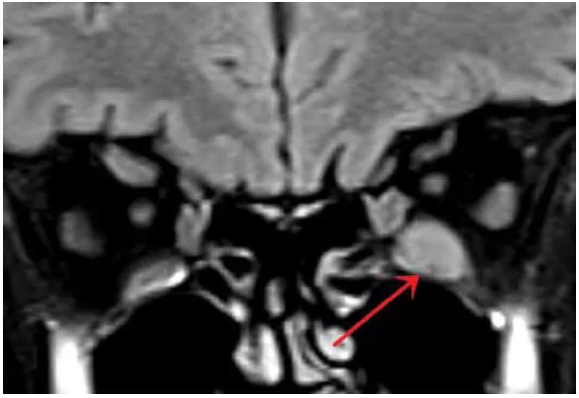 Magnetic resonance - coronal image of orbits, T2 weighted fat-suppressed STIR image
(short tau inversion recovery) showing increased signal of left inferior rectus muscle