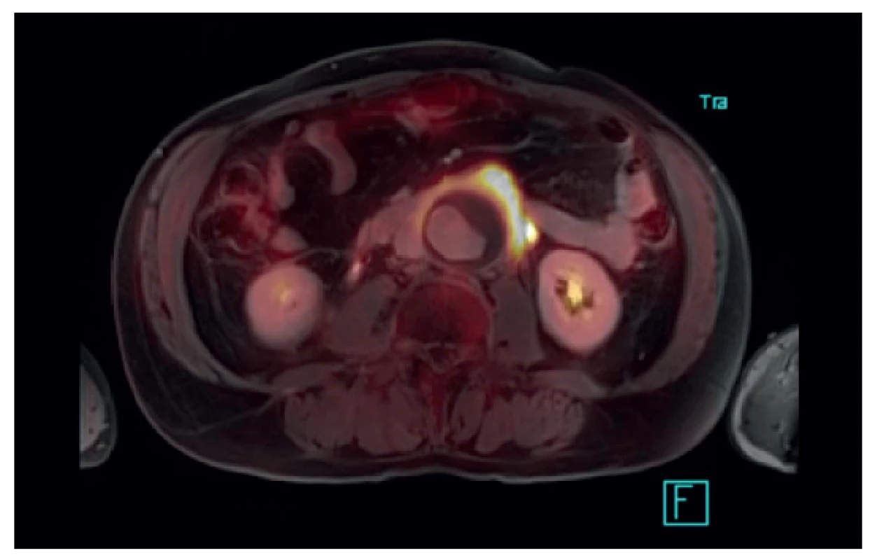 PET/MR – inflammatory AAA